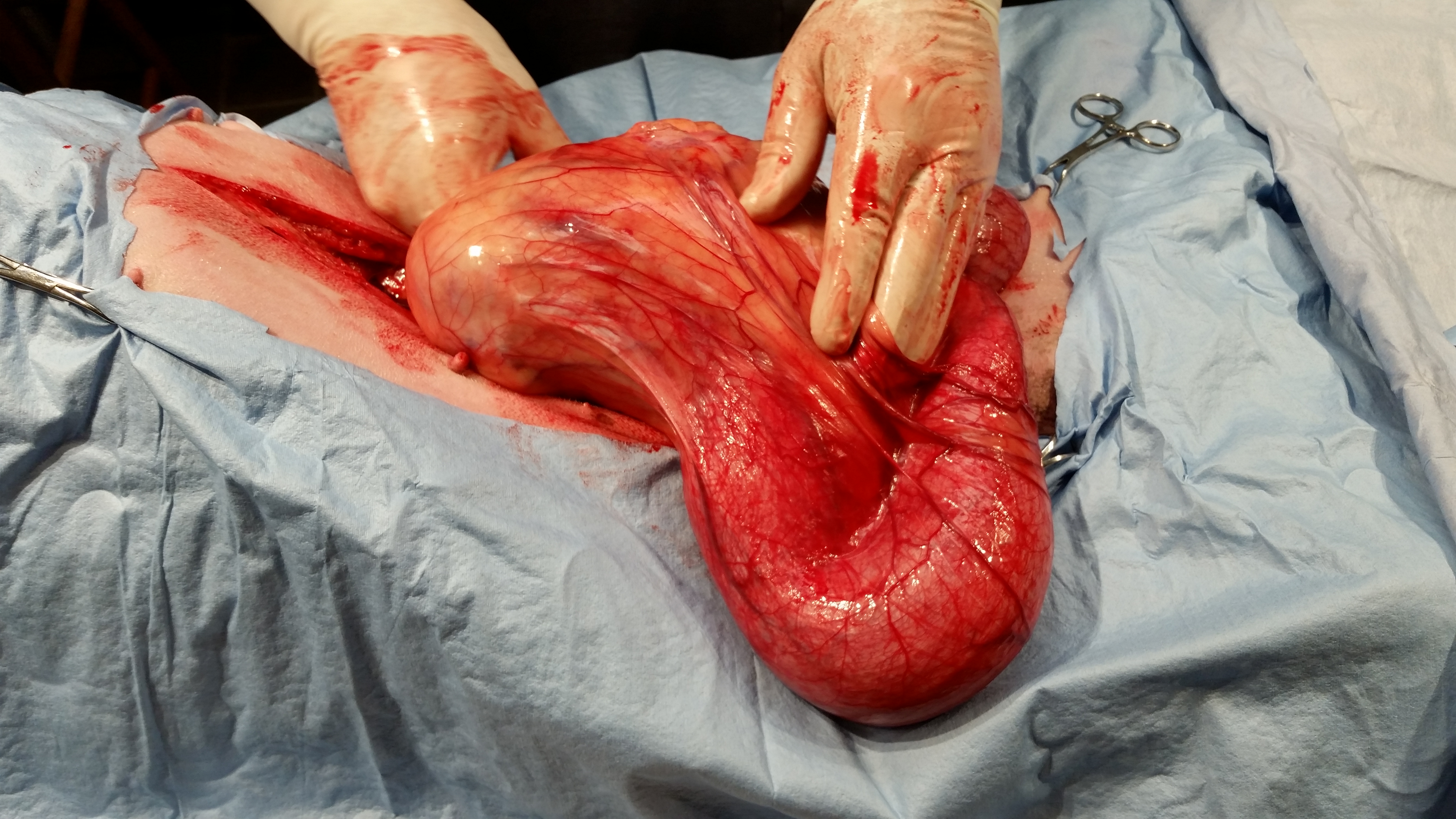 Hydronephrotic kidney and ureter