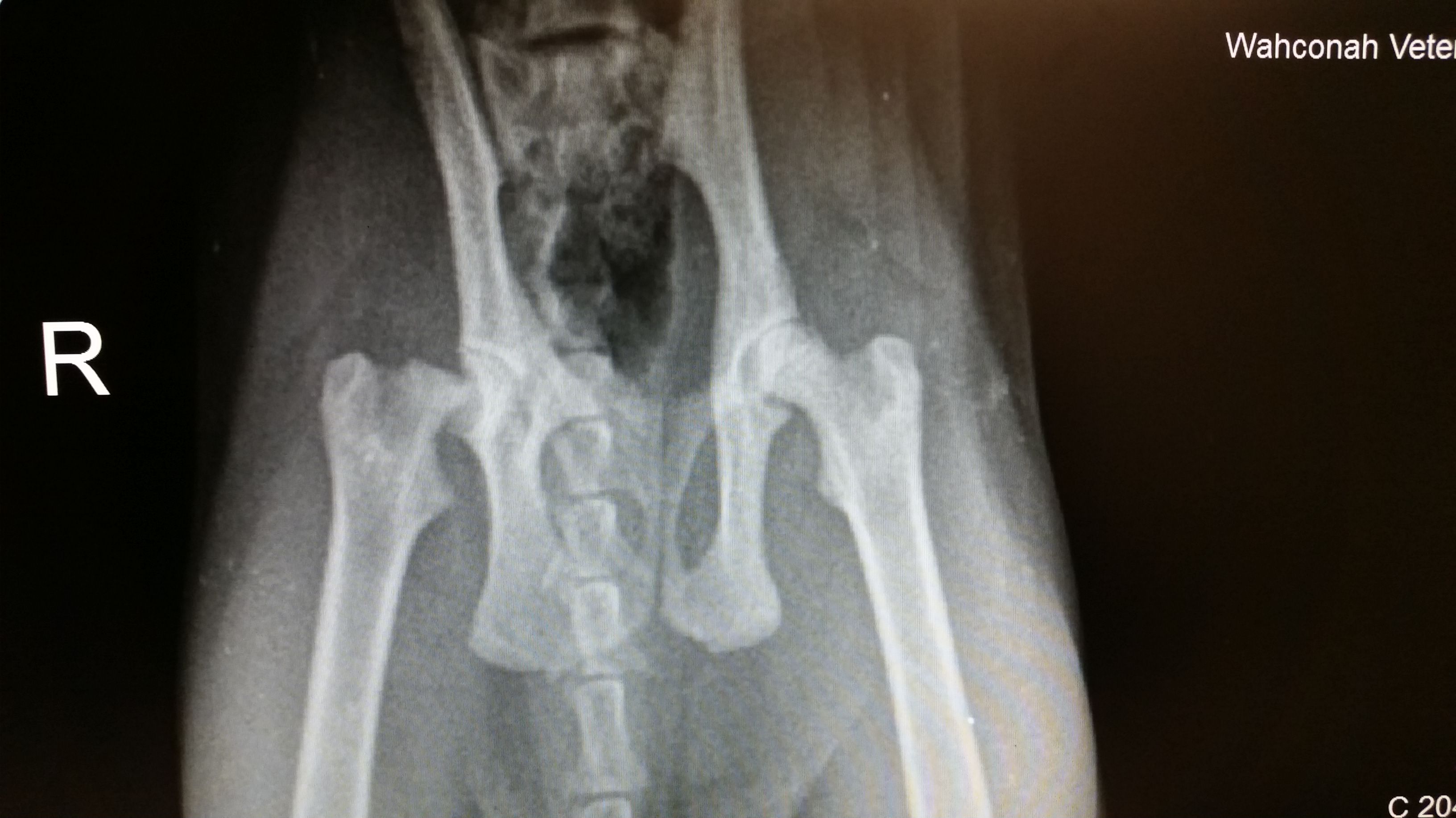 Fracture femoral neck